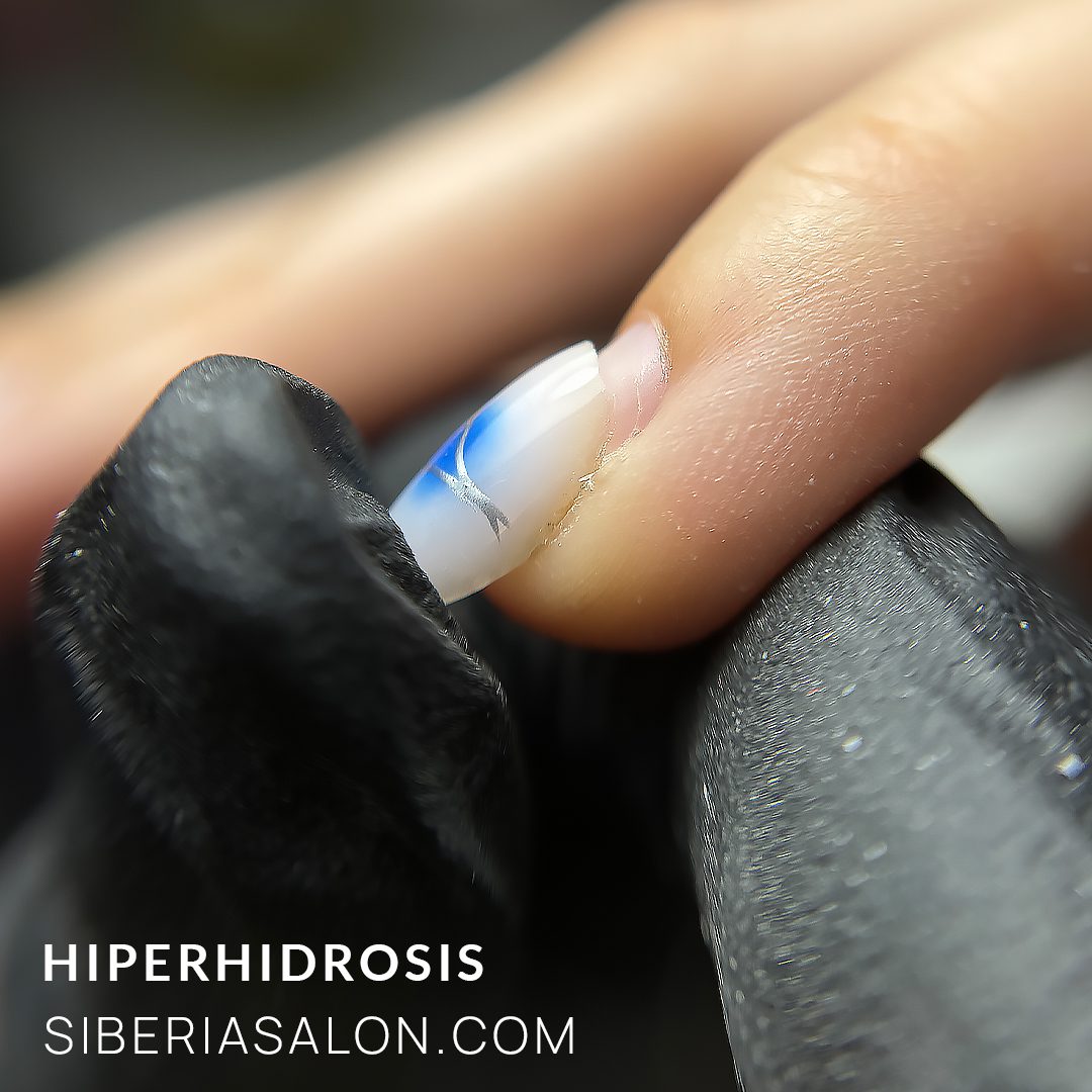 Hiperhidrosis (sudoración excesiva de las manos)